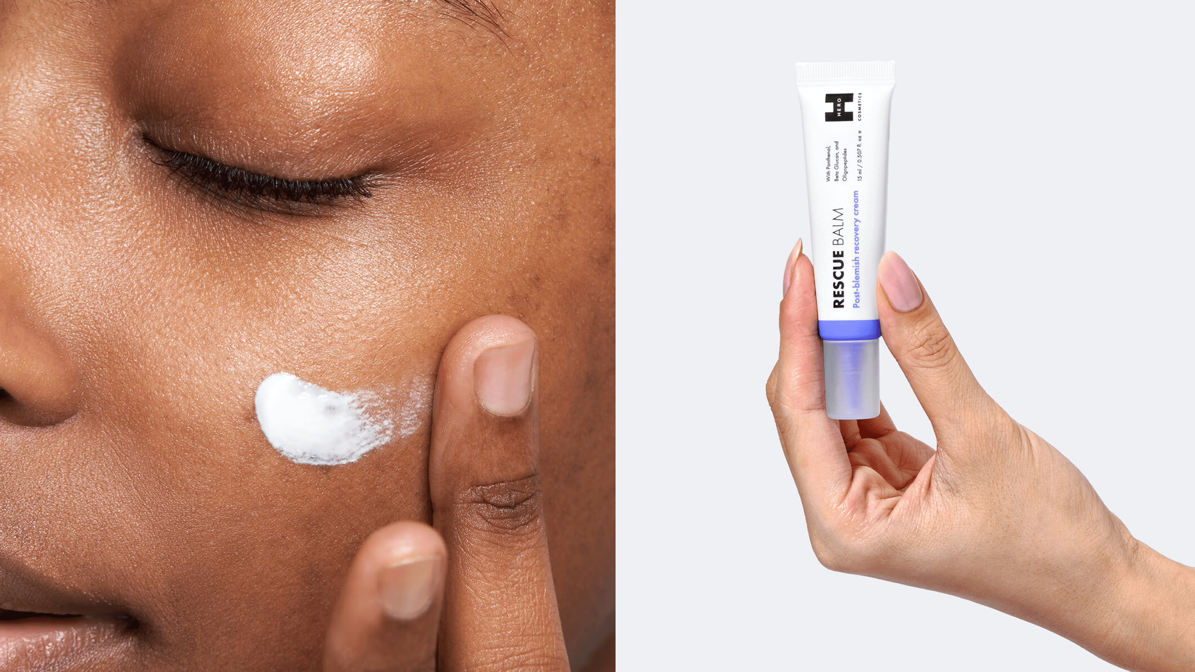 rescue balm to help with the pimple-healing process